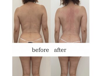 ウニ(uni)/BeforeAfter