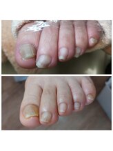 爪切り屋 足楽/肥厚爪