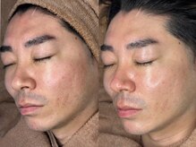 ラナン 恵比寿店(Ranun)/before/after ★ララピール