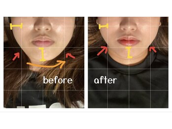 エムユー(Mu)/ボキボキしない小顔矯正