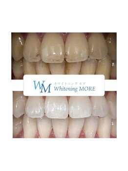 ホワイトニング モア(Whitening MORE)/ヤニ汚れも落ちます!