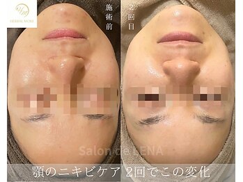 サロンドレナ 名駅店/ハーブピーリング サロンドレナ