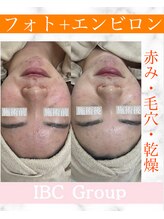 トータルサロンアイビーシー(トータルサロンIBC)/光フェイシャル+エンビロン