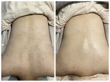 ラヴィオス 渋谷表参道店(RAVIOS)/肌質改善 ハーブピーリング背中