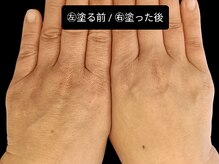 ベリッセ(Belisse)/【Lien】Before/After