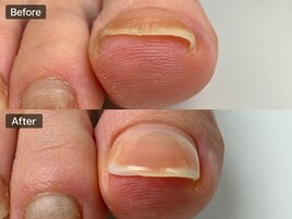 巻き爪矯正ビフォーアフター