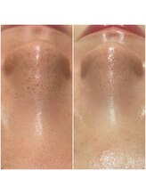 エッグスキン 豊田(egg skin)/　REVIハーブピーリング