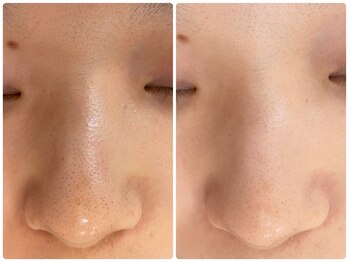 ジェイ(J)/毛穴に特化のフェイシャルエステ