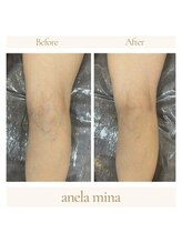 アーネラミーナ(Anela mina)/血行不良による静脈も改善