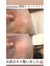 ビューティリュクス(beauty luxe)/熊本市初導入のプラズマニア