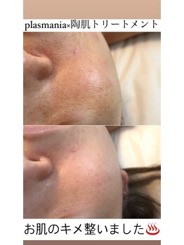 ビューティリュクス(beauty luxe)/熊本市初導入のプラズマニア