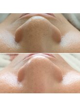 ドクターボディ 新宿店(Dr.Body)/毛穴洗浄ハイドラワン