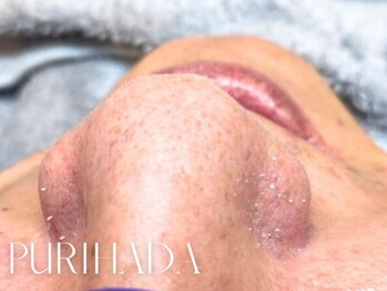 ザ ベルネス(The bellness)の写真/毛穴徹底改善！黒ずみ・角栓・ゴワつきを根本改善!!【ハイドラ毛穴洗浄￥4,900～】つるんとしたお肌に♪