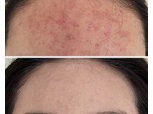 北原美顔/10代女性/ニキビケア