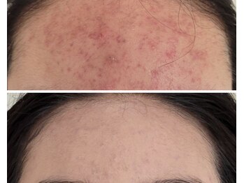 北原美顔/10代女性/ニキビケア