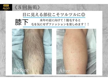 アルゴ 豊中岡町駅前店(ALGO)/【メンズ 全身脱毛】
