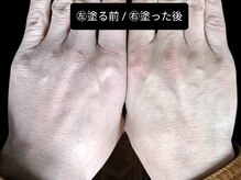 ベリッセ(Belisse)/【Lien】Before/After