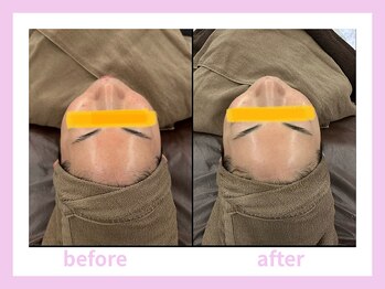 キワミビューティ(KIWAMI BEAUTY)/塗る金の糸/ビフォーアフター