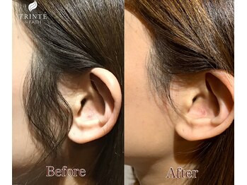 トリンテ バイ フェース(TRINTE by FAITH)/【もみあげ脱毛】7回(4週間隔）