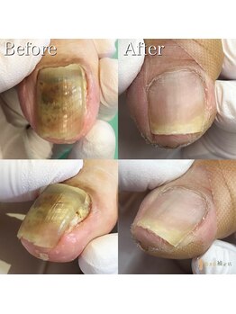 巻き爪補正店 越谷店/変形爪補正