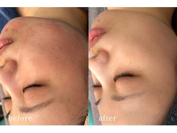 サロンムーン 赤坂(salon moon)/突然の痒みもお任せください