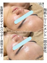 クレヴィー(Creviy)/メンズ陶肌トリートメント