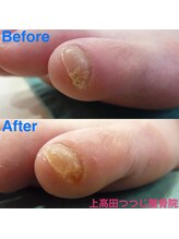 上高田つつじ整体院/フットケア　副爪ケア　施術例