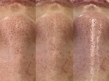 ソルシエール/韓国式3D毛穴洗浄