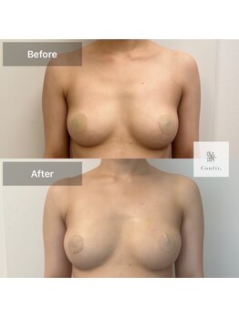 エミット(emit.)/産後のバストのたるみにも◎