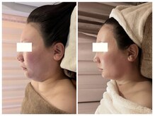 ビクシー(Bixie)/脂肪分解剤