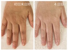 キレイテ 福岡天神店/50代/4回目【天神ハンドケア】