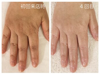 キレイテ 福岡天神店/50代/4回目【天神ハンドケア】