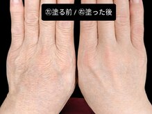 ベリッセ(Belisse)/【Lien】Before/After