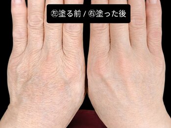 ベリッセ(Belisse)/【Lien】Before/After