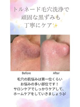 ムーン(MOON)/トルネード毛穴洗浄