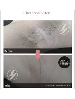 ビュール(VIERU)/レディース部分脱毛【脇】