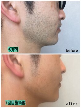 ソウ(SOU)/メンズ　ヒゲ脱毛