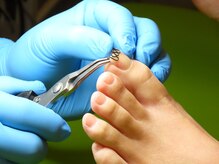 ひかわ整骨院 熊本巻き爪センター/巻き爪矯正３