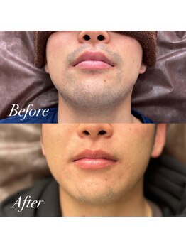 ボス 大曽根店(BOSS)/ヒゲ脱毛で第一印象UP!