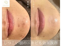 サロンドレナ 名駅店/ハーブピーリング サロンドレナ