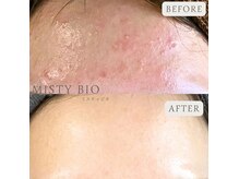 《長く繰り返していたニキビケア》6ヶ月の効果です。