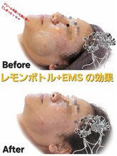 ベリー(Berry)/レモンボトル+EMS