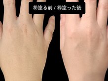 ベリッセ(Belisse)/【Lien】Before/After