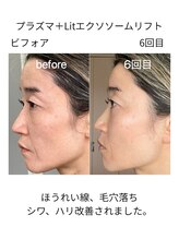 フラワー(FLOWER)/Lit私の肌変化6回目