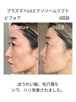 フラワー(FLOWER)/Lit私の肌変化6回目