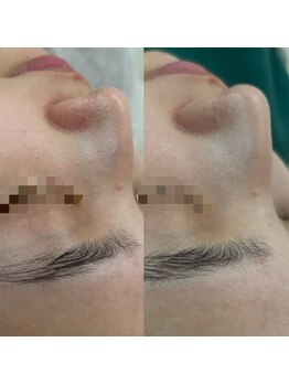 ファーファラ(Farfalla)/毛穴洗浄×水光ピーリング