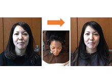 レメディ/美容鍼コース