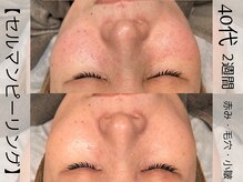 ウイ ネイルアンドビューティー(u'i nail&beauty)/赤み・毛穴・小皺　が悩みでした
