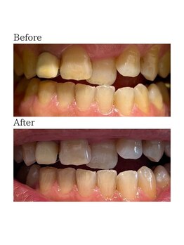 ノーブル 上土店(Noble)/ホワイトニングBeforeAfter