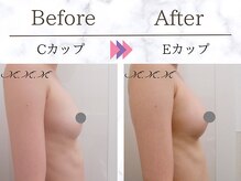 メディカルサロン エム エム エム 銀座プレミアムサロン(M.M.M.)/【バストアップ例】　C→Eカップ
